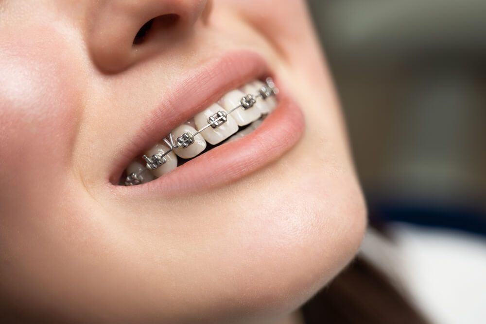 The Benefits of Braces: Why Orthodontic Treatment is Worth the Investment