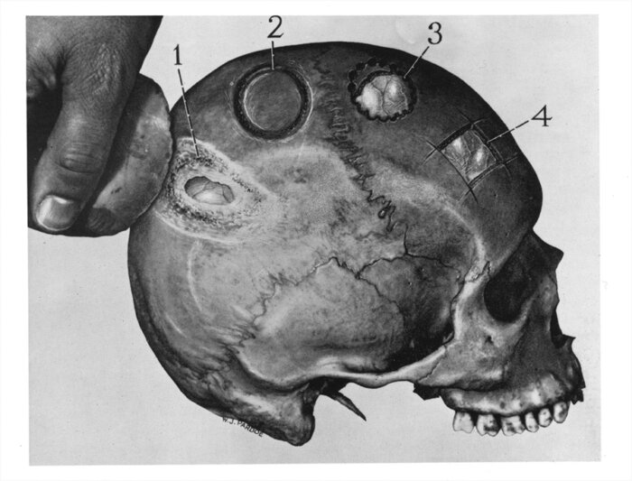 Evolution of Neurosurgery: From Trepanation to Modern Techniques