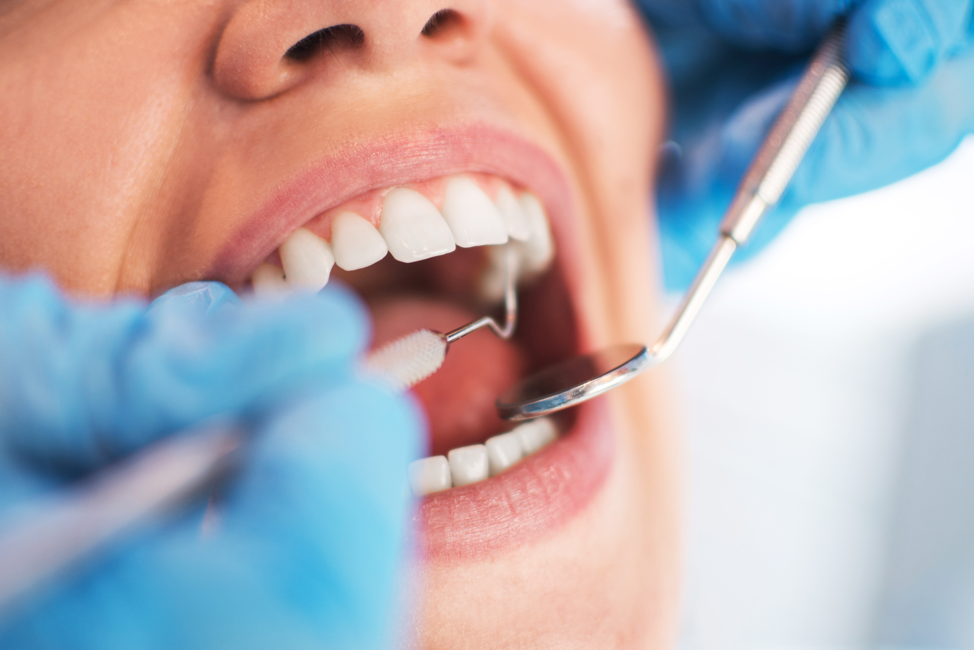 Sealants: A Proactive Approach to Protecting Your Dental Health