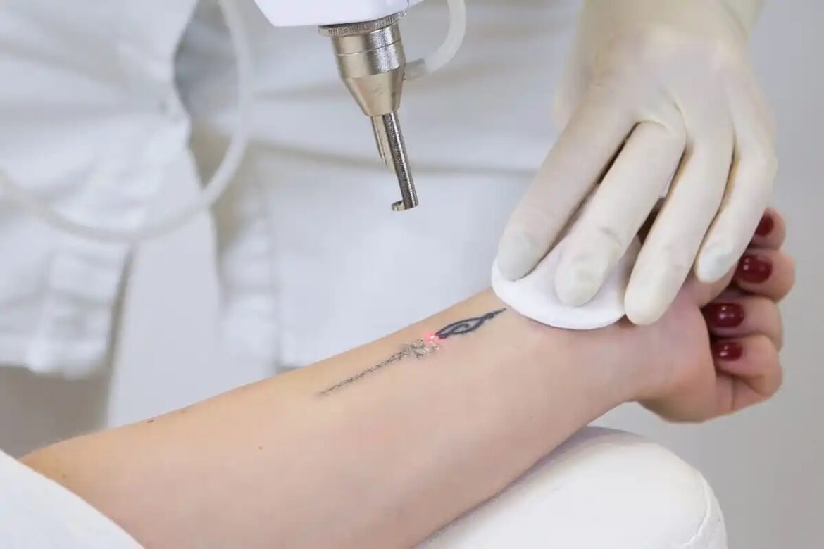 Neatcell Tattoo Removal Reviews: Unveiling the Truth Behind the Hype